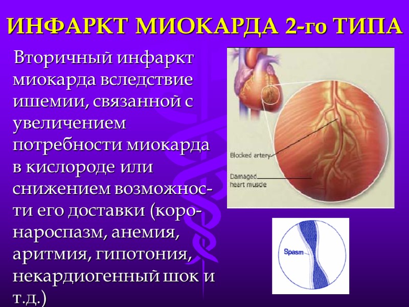 ИНФАРКТ МИОКАРДА 2-го ТИПА Вторичный инфаркт миокарда вследствие ишемии, связанной с увеличением потребности миокарда